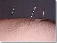 Op de meridianen liggen acupunctuur punten. Dit zijn punten met een doorsnee van ongeveer een millimeter. 